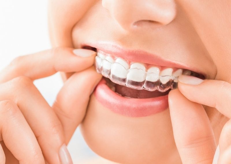 How Does Online Teeth Straightening Work